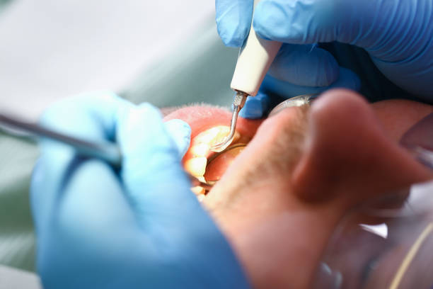 Best Emergency Tooth Extraction in Wardsville, MO