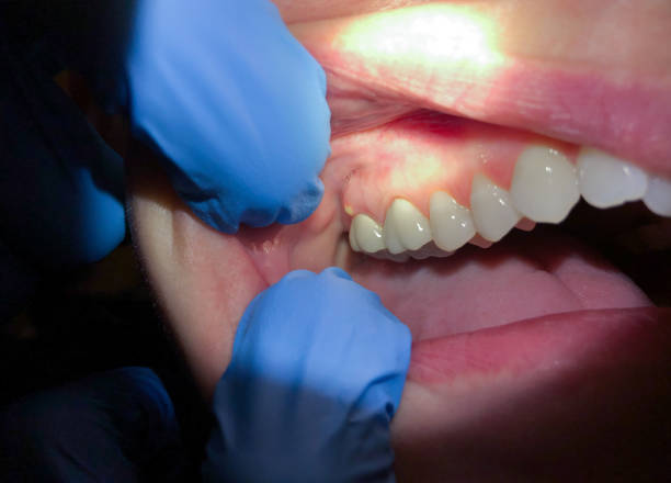 Best Emergency Wisdom Teeth Removal in Wardsville, MO